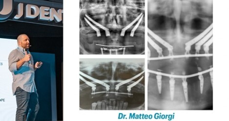 Riabilitazione implanto-protesica con la chirurgia zigomatica - Odontoiatria Italia