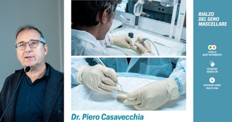 Rialzo del seno mascellare - dr. Casavecchia - Odontoiatria Italia