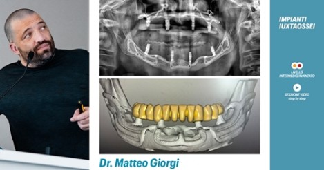 Tecnica chirurgica con impianti iuxtaossei - Odontoiatria Italia